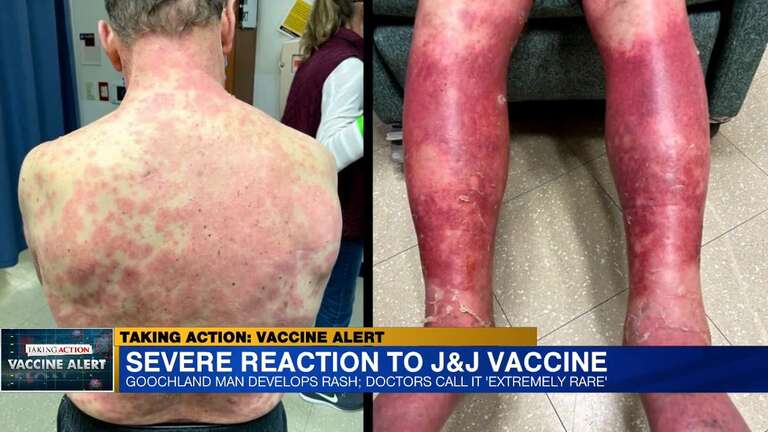 Idoso tem reação grave e muito rara à vacina da Johnson & Johnson