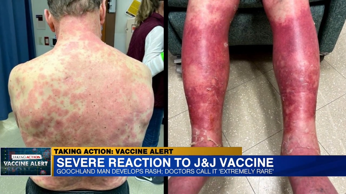 Idoso tem reação grave e muito rara à vacina da Johnson & Johnson