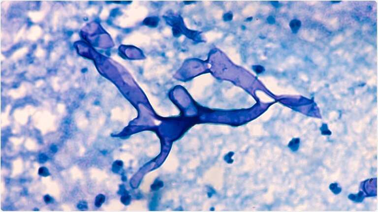 Saiba mais sobre a mucormicose causada pelo fungo preto 