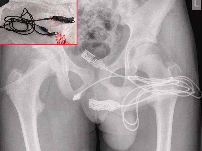 Adolescente britânico é operado após inserir cabo USB no pênis