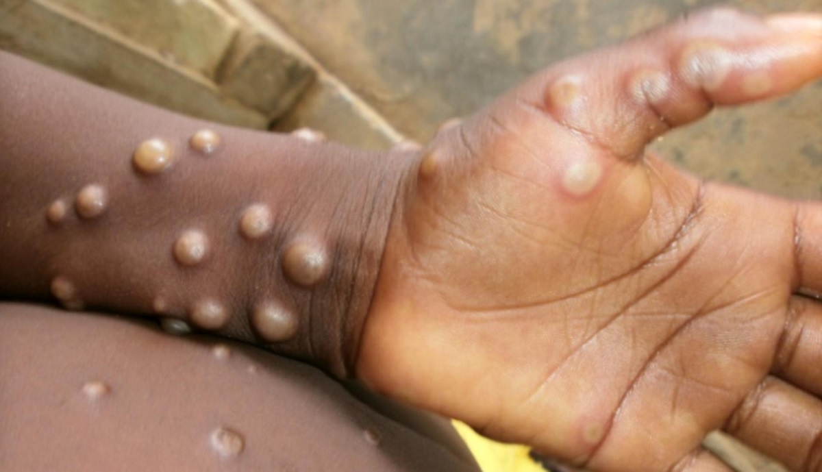 Centro Europeu de Prevenção e Controle de Doenças alerta para risco de a varíola do macaco se tornar endêmica na Europa