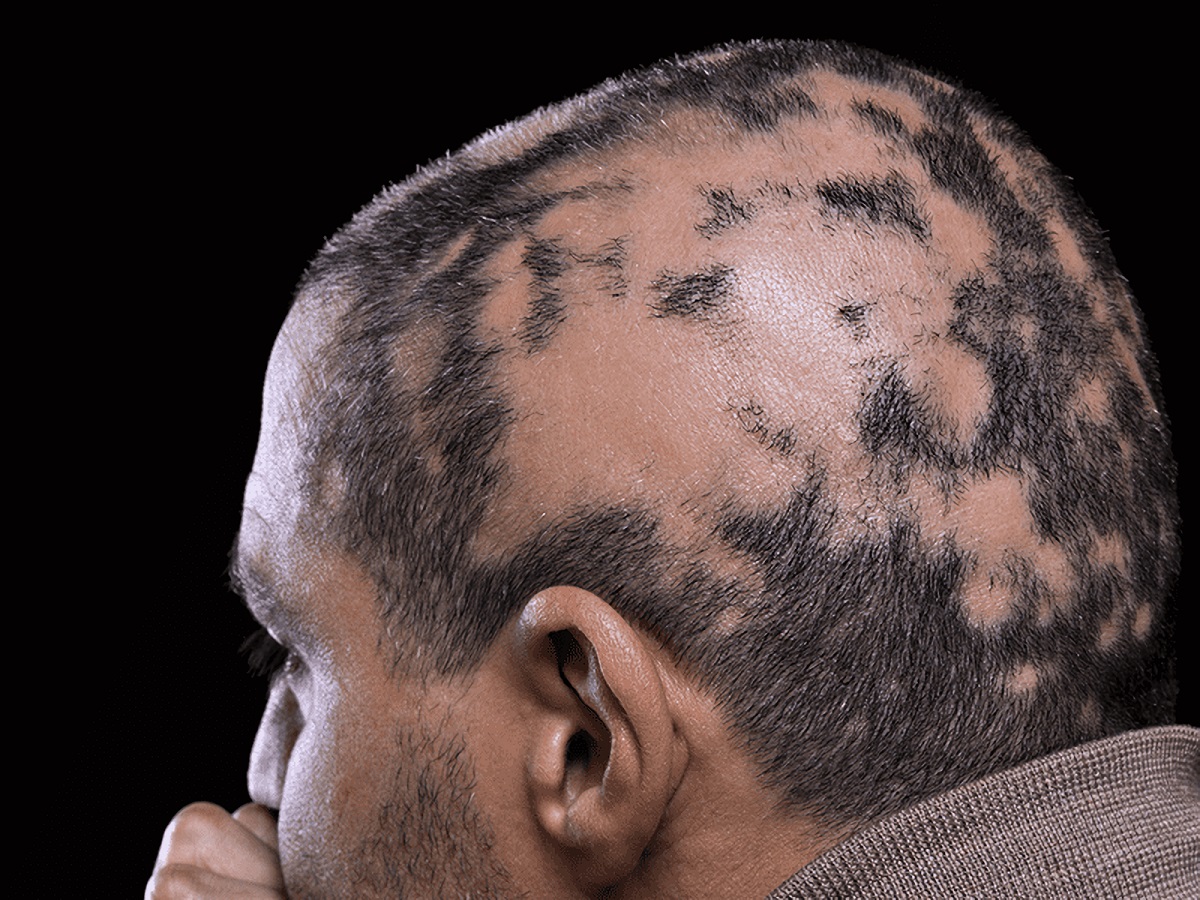 Empresa cria remédio para alopecia areata com 40% de eficácia na recuperação quase total do cabelo