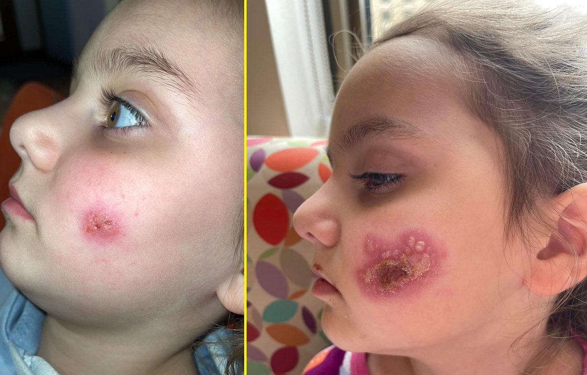 Dia do Beijo: simples sinal de afeto leva menina para o hospital após infecção