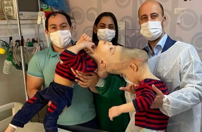 Gêmeos siameses brasileiros unidos pelo crânio são separados usando realidade virtual