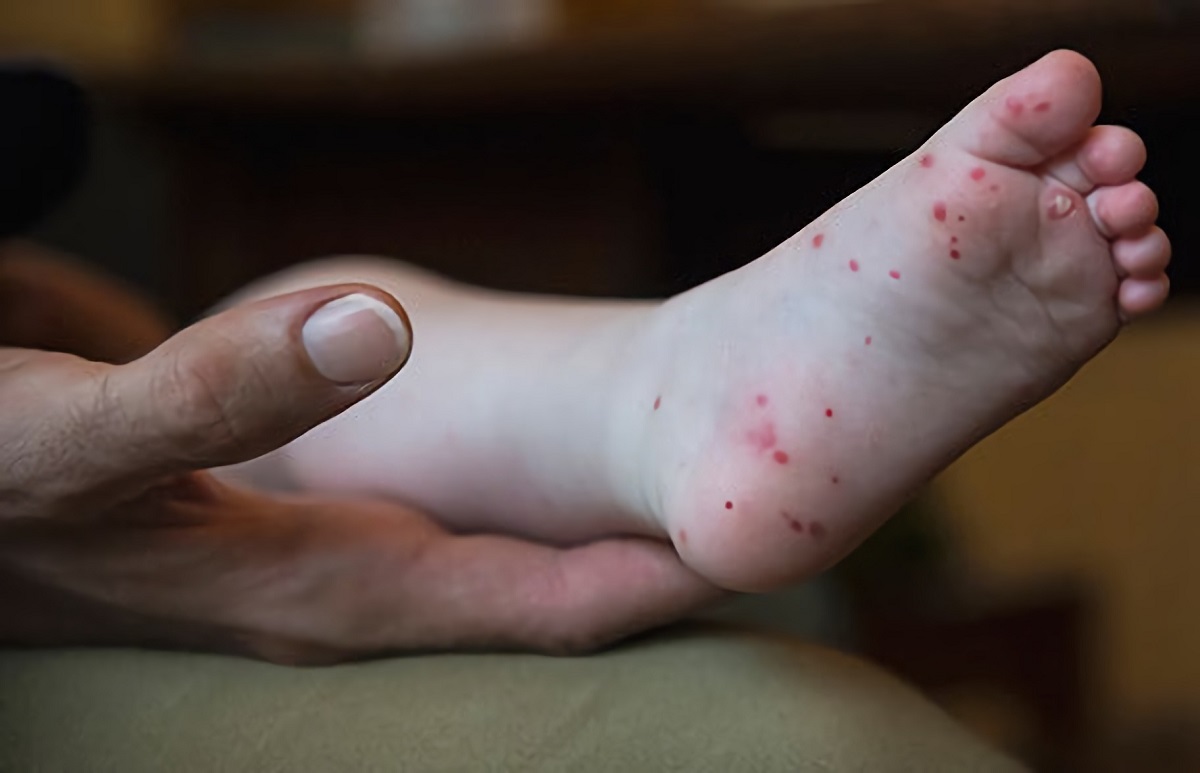 Após covid-19 e monkeypox, agora é a vez da nova doença chamada gripe do tomate?