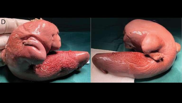 Médicos encontram feto dentro do crânio de uma menina chinesa de 1 ano