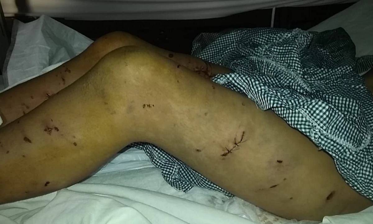 Menino de 9 anos é atacado por 16 cães em Mar del Plata, na Argentina, e sobrevive