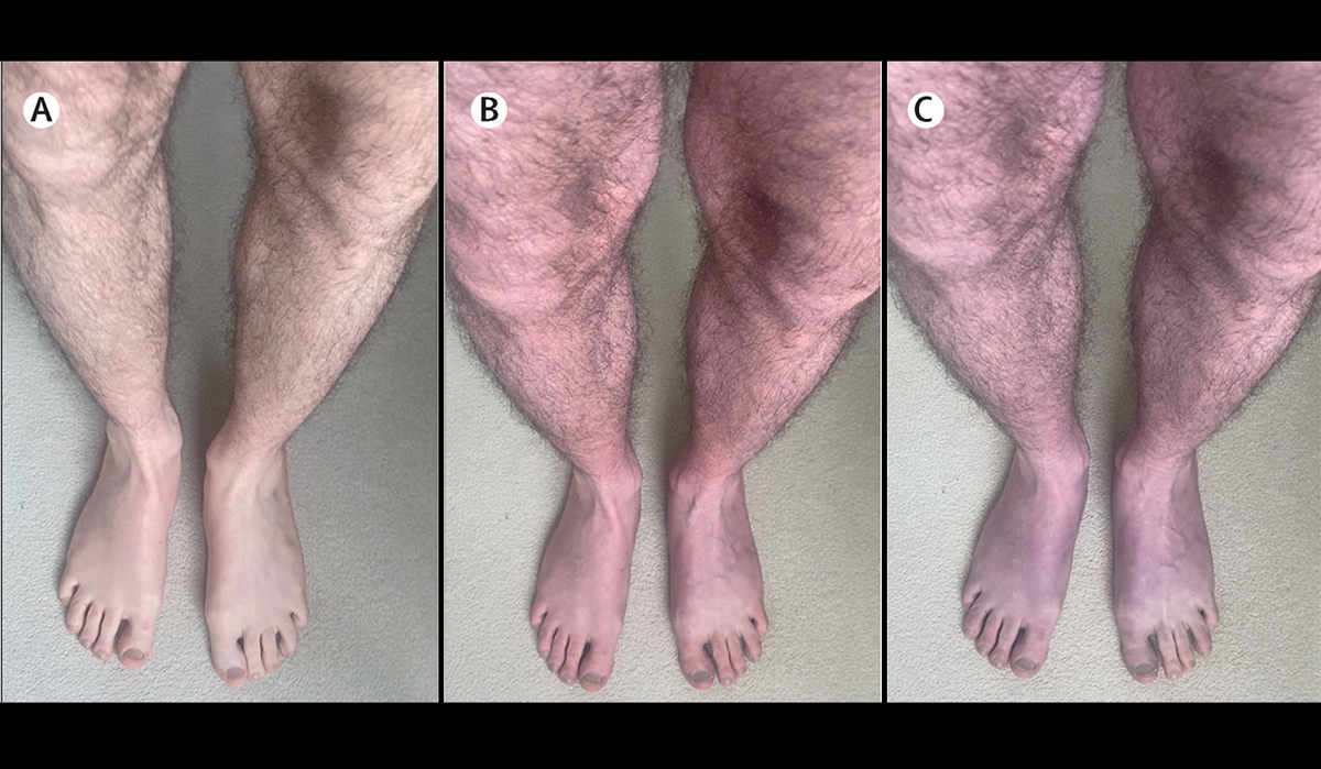 Acrocianose: cientistas descobrem novo sintoma da covid longa que deixa pernas e pés roxos