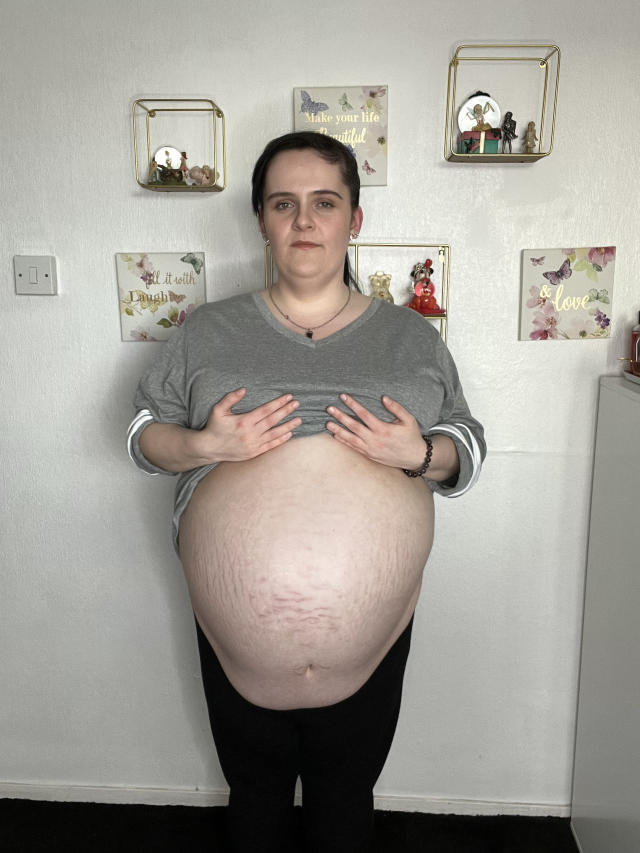 Britânica retira cisto de 40 cm e quase 16 kg da barriga, que parecia de grávida
