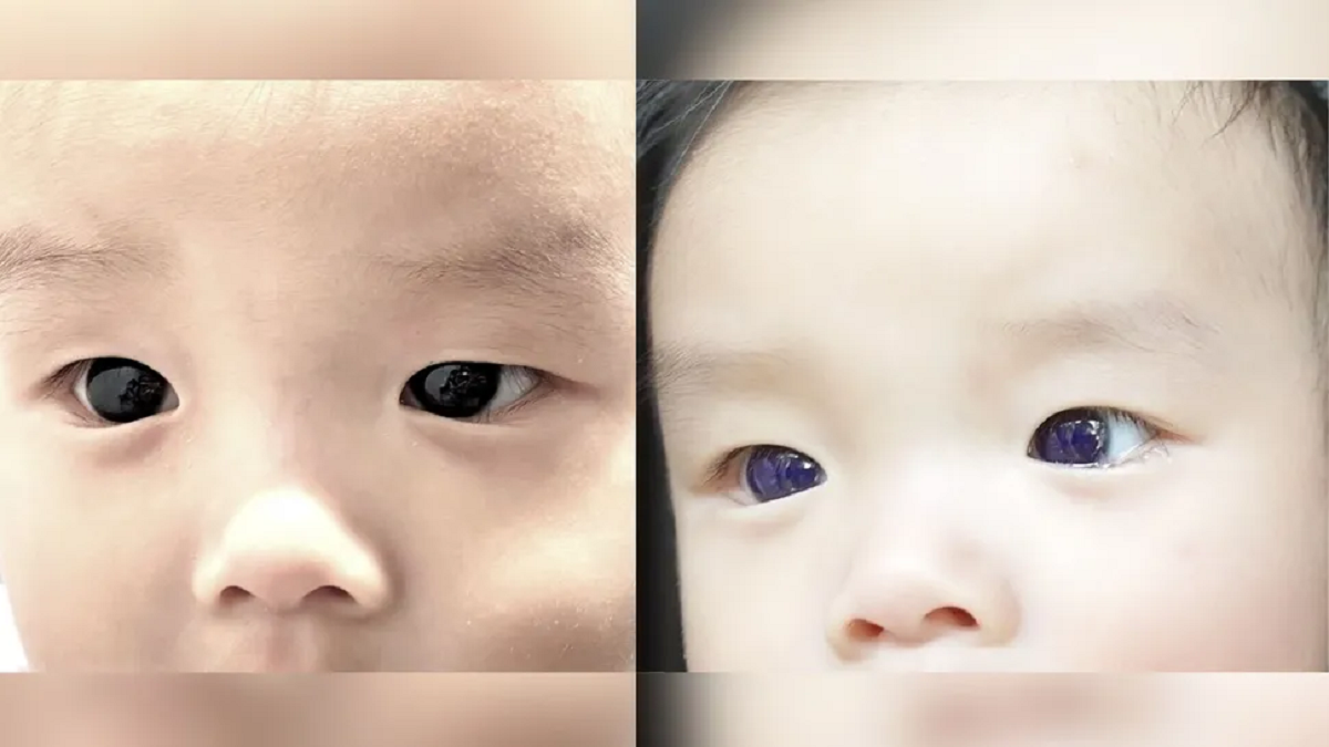 Efeito bizarro: olhos de bebê tailandês mudam de cor após uso de remédio para covid-19