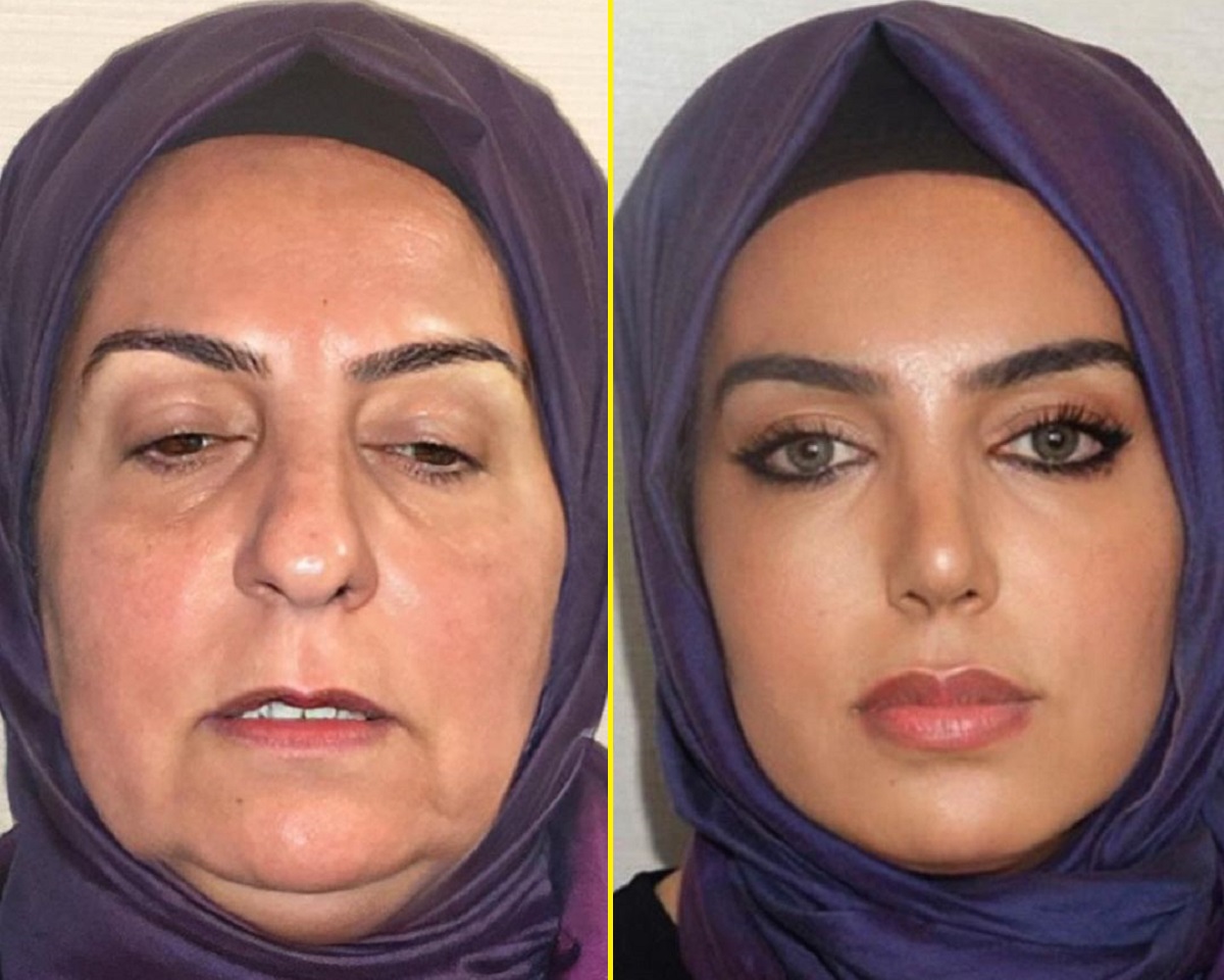Antes e depois de cirurgia plástica em idosa na Turquia está causando polêmica no Instagram