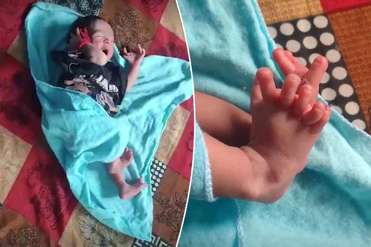 Bebê nasce com 26 dedos na Índia e é considerada a encarnação de uma deusa hindu