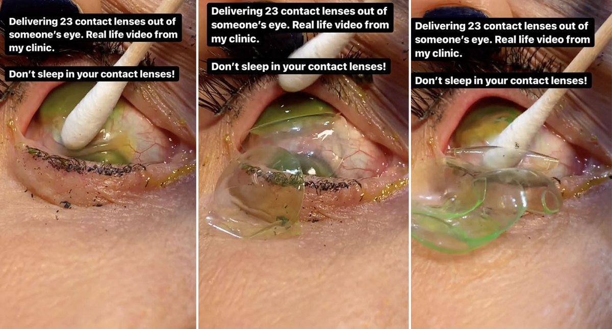 Bizarro! Nos EUA, médica retira 23 lentes de contato do olho de paciente
