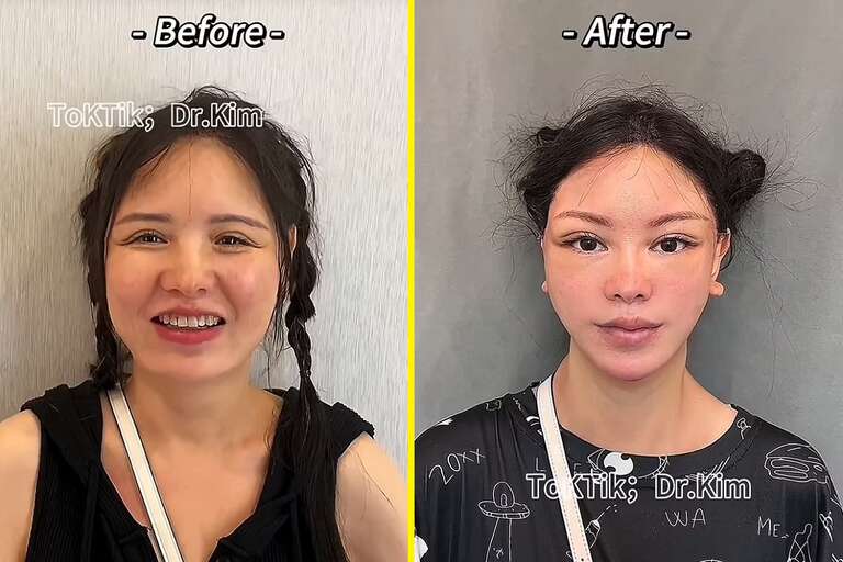 VÍDEO: médico causa polêmica no TikTok com antes e depois de suas cirurgias plásticas
