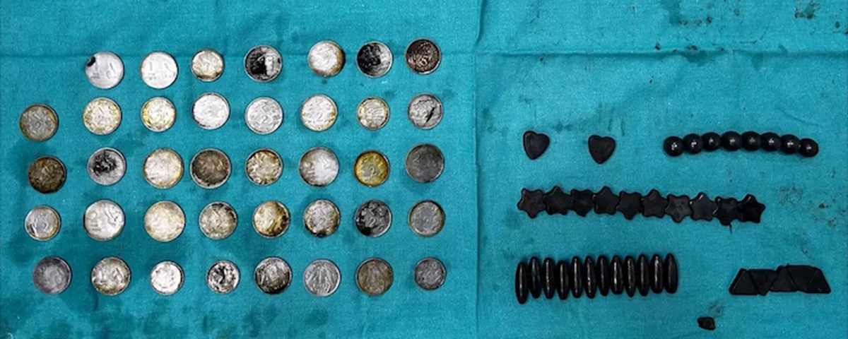 Médicos retiram 39 moedas e 37 ímãs do interior de fisiculturista indiano que os engoliu para “absorver zinco”