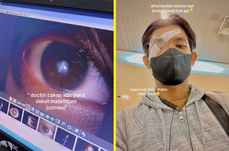 De tanto esfregar o olho, jovem malaio acaba no hospital para tratar lesões na córnea
