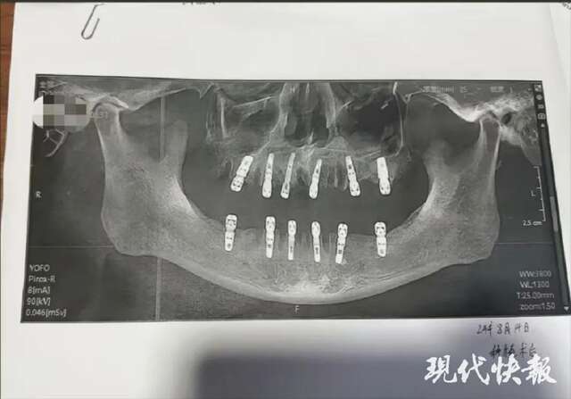 Saiba mais sobre a mucormicose causada pelo fungo preto 